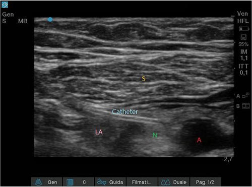 Figure 2 Continuous Adductor Canal Block (cACB): catheter tip anterior position. A 20 Gauge catheter was inserted through the split cannula anteriorly to the saphenous nerve. Sartorius muscle (S); saphenous nerve (N); femoral artery (A); local anesthetic (AL).
