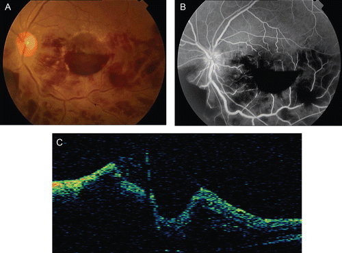 FIGURE 2  (a) Retinal hemorrhages and sheathing were significantly reduced and premacular hemorrhages were gravitated inferiorly within 2 days. (b) Note the absence of vascular leakage in fluorescein angiography. (c) Note irregular contour of fovea caused by extensive premacular hemorrhage.