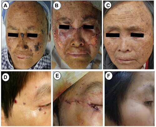 Figure 3. Clinical picture of two patients in S-PDT group. (A) Multiple basal cell carcinomas of the facial ministry in a 52-year-old woman. (B) Clinical photograph immediately after superficial shaving treatment. (C) Clinical photograph after a follow-up of 12 months. (D)Basal cell carcinoma of the right eye periphery in a 56-year-old woman. (E) Clinical photograph after simple excision and suturing. (F) Clinical photograph after a follow-up of 24 months.