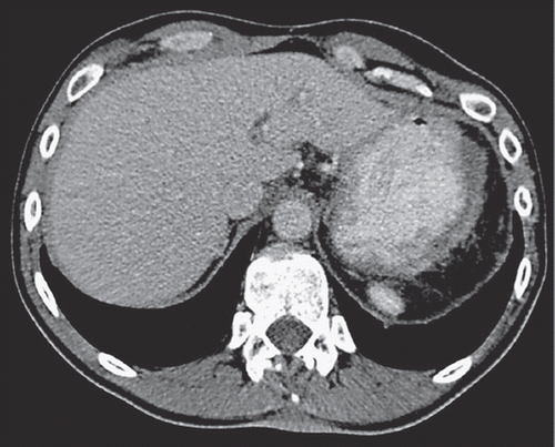 Figure 2. Contrast-enhanced axial CT image during the portal venous phase shows complete regression of the MPeM in the left upper quadrant of the abdomen consistent with adequate response to chemotherapy.