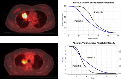 Figure 1. Transverse view of CT-PET scan of NSCLC patients. Examples of intensity volume histograms for the two patients are shown on the right. Maximum SUV for patients A and B (top and bottom left) are, respectively, 10.1 and 6.3. From the RVRI curves, it can be inferred that the minimum SUV is around 8% (0.80) and 20% (1.25) of the maximum uptake. AVAI curves confirm that all the tumor volume is above these minimum uptake values for the corresponding patient.