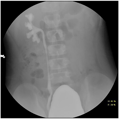 Figure 2. Micturating cystourethrogram image showing right grade-III vesicoureteric reflux. Mild bladder wall irregularities are present. No reflux is seen on left side.