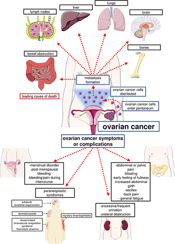 Figure 1 Symptoms and complications of ovarian cancer and the most common sites of metastatic foci.