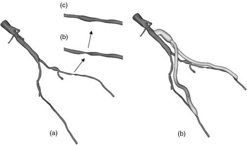 Figure 7. Two surgical alternatives for the 67-year-old female. (a) The preoperative model constructed prior to surgery. (b) A close-up of a high-grade stenosis in the left femoral artery. (c) The idealized endovascular repair (angioplasty and stenting), and (d) an aorto-femoral direct reconstruction using a Dacron bifurcating graft. [Color version available online]