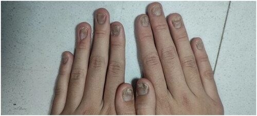 Figure 3. Week 12 improvement of nails psoriasis (NAPSI = 30, DLQI = 15).