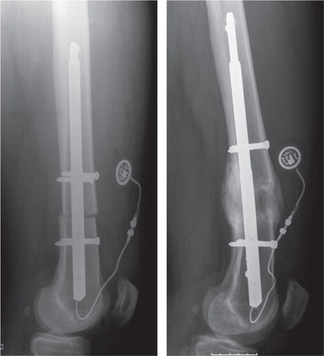 Figure 8. A patient in the nail group (pair 4) with a relatively spacious femoral canal. Procurvatum deformity occurred throughout the course of lengthening. The proximal fragment rotated at the plane of the single proximal locking screw. Blocking screws in the proximal fragment in the frontal plane should have been placed to avoid this angulation.