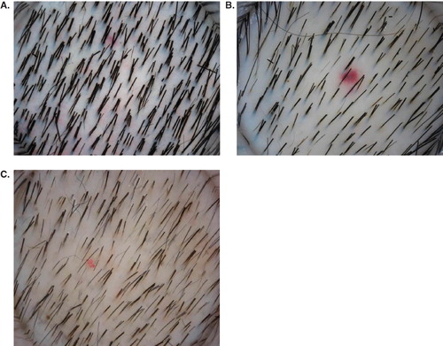 Figure 3. Dermatoscopic images of the scalp in different stages of alopecia. (A) Normal scalp with compound hair in most follicles. (B) Early androgenetic alopecia with mixture of compound and single hair. (C) Advanced androgenetic alopecia with a thin, single hair in most follicles.