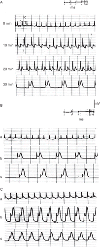Figure 3.  ECG traces showing (A) the effect of direct perfusion of isolated toad heart with crude extract solution (2 μg/ml) of C. procera on the electrocardiogram of isolated toad heart at different time intervals; (B) the effect of adding atropine (4 μg/mL) after crude extract application, and (C) the effect of adding verapamil (5 μg/mL) after crude extract application (a) before treatment, (b) 20 min after treatment, (c) after adding blocker.