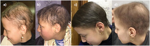 Figure 2. Patient 1 follow up. a) before treatment, b) after 6 months treatment with topical 2% topical minoxidil only, c) after adding platelet rich plasma sessions to topical minoxidil for 1 year, d) worsening of the condition after stopping platelet rich plasma sessions.