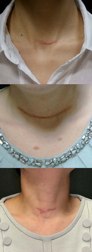 Figure 2. Clinical photographs of random patients with thyroid operation scars (< 1 year) who did not receive any treatment.