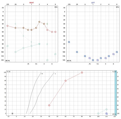 Figure 1. Hearing loss due to APS and with steroid treatment. A. First audiometry (Red and blue lines) performed at the first audiological appointment, which shows moderate right sensorineural hearing loss and left anacusis. The verbal audiometry of the right side shows a maximum phonemic discrimination of 100% at 80 dB and left anacusis. B. Second audiometry (aquamarine lines) performed 20 days after starting steroid treatment, in which profound hearing loss of the right sensorineural type and left anacusis are evident in the audiogram. The phonemic discrimination on the right side dropped dramatically until it discriminated 20% at 110 dB.