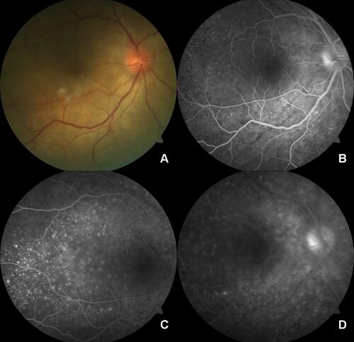 Figure 2 (A) Fundus photo of the posterior pole of the sympathizing eye shows a blurred margin of the optic disc, radial retinal folds around the optic disc, and subretinal fluid at the posterior pole. (B) FFA image at early venous phase shows disc leak, choroidal folds, and pinpoint leaks. (C) FFA image at mid-venous phase shows the typical multiple pinpoint leaks more clearly. (D) FFA image at late venous phase shows disc leak and blurred margins of pinpoint leaks.
