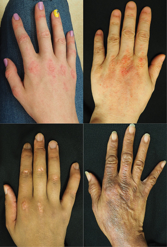 Figure 4 Gottron’s papule appearance varies across skin tones presenting as pink to violaceous to hyperpigmented macules and papules over dorsal hands with predominance over metacarpophalangeal joints.