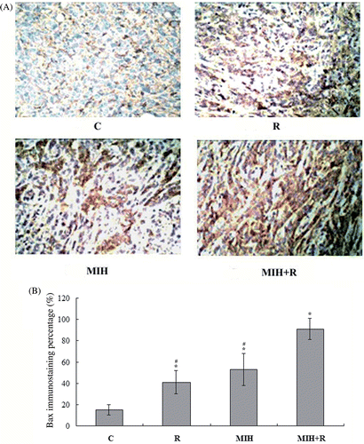 Figure 2. Immunohistochemical detection of Bax expression in the primary tumour. (A) Immunohistochemical analyses were performed to determine Bax expression in the primary tumour at the 4T1 cell injection site 25 days after the treatments. Positive staining for Bax was brownish in colour. Magnification, ×200. (B) Bax positive cells were counted and a percentage was calculated as follows: Bax positive cells/total tumour cells × 100%. The Bax immunostaining percentage in the tumour was compared among treatment groups: C, tumour-bearing control; R, radiotherapy; MIH, magnetic induction hyperthermia; MIH + R, magnetic induction hyperthermia plus radiotherapy. *P < 0.05 compared with group C; #P < 0.05 compared with group MIH + R.