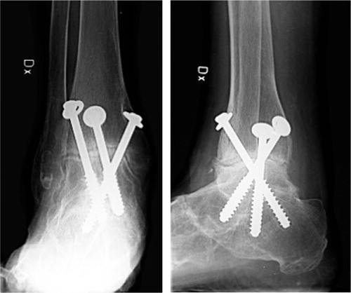 Figure 1. Ankle no.12.Radiographs (A and B) obtained 5 years after percutaneous surgery.The ankle has not become fused.