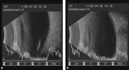 FIGURE 4  USG B scan of right eye showed high reflective echoes corresponding with the larva in the vitreous cavity, while left eye was normal with no evidence of larva.