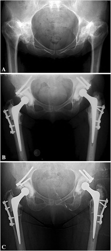 Figure 10. (A) Preoperative radiograph of a 55-year-old woman with bilateral DDH, classified as a Crowe III, Hartofilakidis C, and Edinburgh system A2 F3. (B) Postoperative radiograph showing bilateral reconstruction using roof grafts and a cemented Exeter THA after femoral shortening osteotomy. (C) Radiograph 15 years after the reconstruction showing incorporation of the roof grafts without evidence of loosening or resorption of the graft but signs of wear.