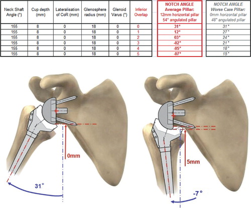 Figure 8. influence of inferior prosthetic overhang on the notch angle. (Simulation of maximal adduction in average scapular morphology and in worse-case scapular anatomy: no horizontal pillar. Images of average scapular morphology).