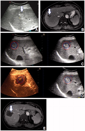 Figure 2. A 82-year-old female patient had a 24 mm HCC tumour in segment 8, which was shown (arrow) on (A) 2D US and (B) CEMRI. (C) The 3D US-US fusion imaging of the lesion before RFA. The real-time US image is shown at left, and the pre-ablation 3D US image is shown at right. (D) Assessment of the ablation effect on 3D US-CEUS fusion imaging after RFA. The non-perfusion area covered the entire lesion with 5 mm AM. The assessment result was Grade A. (E) CEMRI one month after RFA demonstrated the technique effectiveness of the ablation (arrow).