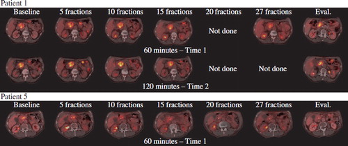 Figure 1. Illustrate the FDG-PET/CT scans of patient one and five. Patient one did not become resectable after CRT, and progressed with liver metastases detected by EUS at the time of evaluation. Patient 5 became resectable and had a curative resection performed.