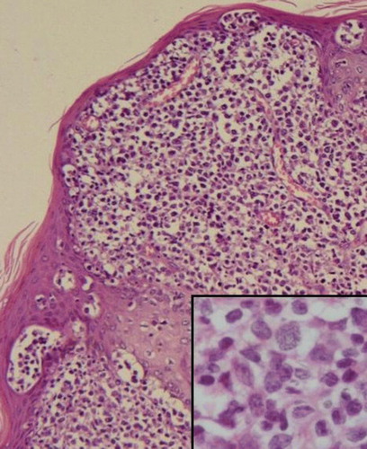 Figure 3.  Peripheral Tcell lymphoma, unspecified pattern. Patient with primary cutaneous tumoral ATL. Medium and large cells infiltrating the dermis with Pautrier's abscesses (HE, ×100). Insert: Pleomorphic cells in greater magnification (HE, ×650).