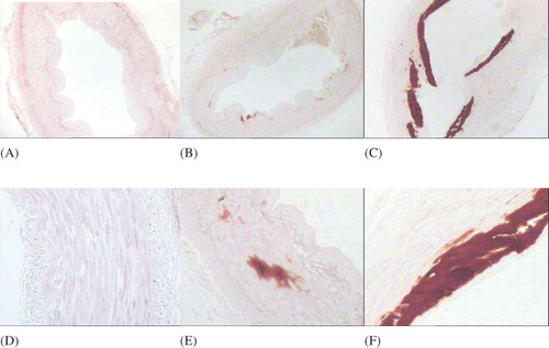 Figure 2.  Alizarin red staining of radial artery.Note: The purple or orange-red calcium deposits can be seen in the calcificated tunica media.