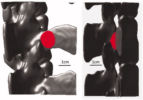 Figure 9. Two 3 D views of the pig bone and simulated lesion showing that the lesion is at the facet joint.