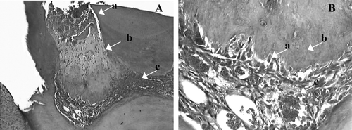 Figure 4 Histologic slide after pulp capping with Aloe vera L. in teeth of rat after 30 days. (A) magnified l0× (a) pulp exposure (b) mineralized tissue, (c) large vases. (B) magnified 40× (a) deeper layer of mineralized tissue, (b) odontoblastes layer reorganization, (c) capillary enhanced (H&E).