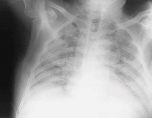 Figure 1. Chest x-ray showing infiltrates of the lower lobes, suggestive of Acute Respiratory Distress Syndrome (ARDS).