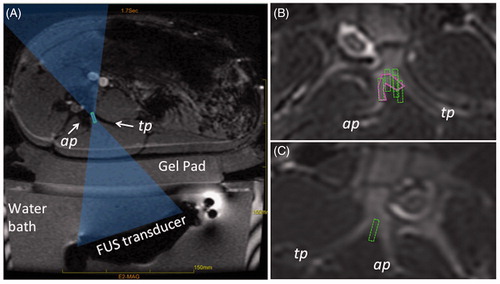 Figure 2. (A) Schematic of a FUS treatment set-up showing the axial MR image of the set-up with a swine positioned on top of the gel pad and the FUS beam focus (green rectangle) placed between the articular and transverse processes (labelled as ap and tp). The FUS beam is aimed directly at the MB nerve. (B) Example of region-of-treatment contour (solid magenta contour) drawn by the operator during the planning phase. Dashed green rectangles represent the focal regions of the individual sonications automatically prescribed by the planning software. (C) Example of planning where no region of treatment was prescribed and instead each sonication’s focal region (dashed green rectangle) was individually placed by the operator.