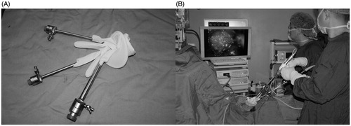 Figure 3. (A) The self-made single-site laparoscopic operation channel. (B) Retroperitoneal LESS-PN surgery.