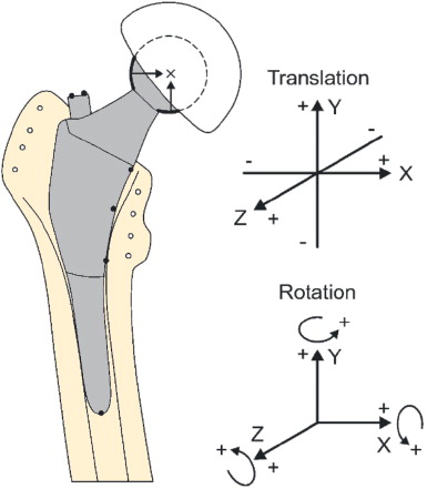 Figure 2. Schematic drawing of the prosthesis with 6 tantalum RSA stem markers and the coordinate system for RSA analysis of 3D micromotion of the femoral stem. In order to explicitly record the direction of micromotion, the directions are marked with + and – signs for both the translations and rotations.