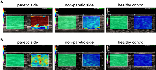 Figure 3 Shear wave elastography of the bilateral biceps brachii muscles (BBM) of stroke patients and healthy individuals, when the upper limbs were positioned at 90° (A) or 45° (B).