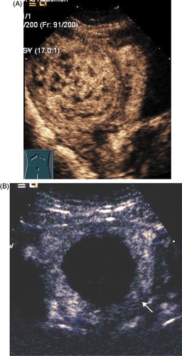 Figure 4. (A) Contrast enhanced ultrasound (ceUS) image of myoma before ablation. The fibroid was obviously enhanced. (B) CeUS of myoma 1 day following ablation showing no ultrasound contrast enhancement in the myoma.
