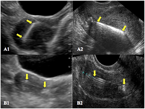 Figure 3. Ultrasonographic images. A - copper IUD entirely within the uterine cavity in a retroverted uterus by both POCUS (A1) and conventional US (A2); B - hormonal IUD entirely within the uterine cavity in an anteverted uterus by both POCUS (B1) and conventional US (B2). The top and the distal end of the IUDs are indicated by yellow arrows.