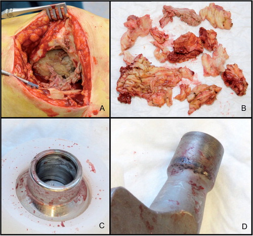 Figure 2. A. Extensive necrosis at the greater trochanter area and destruction of the abductor mechanism. B. Debulking of large amounts of necrotic and fibrotic tissue from the periprosthetic region. C and D. Macroscopic signs of corrosion products at the bore of the Co-Cr head (panel C) and at the trunnion of the femoral component (panel D).