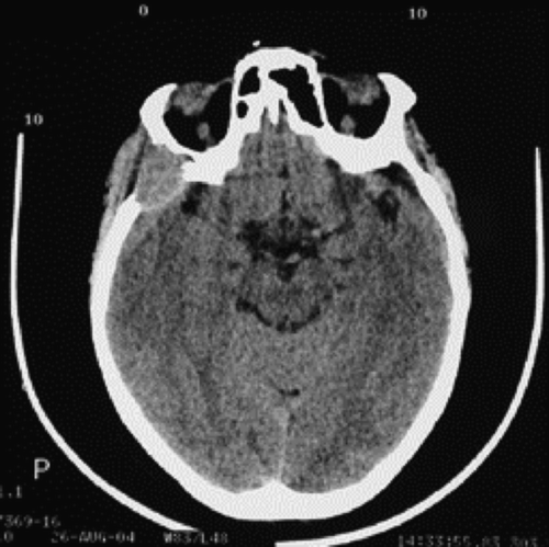 Figure 1.  Craniofacial computed tomography (CT) scan demonstrating an intracranial mass in our PCL patient.