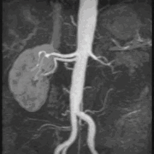 Figure 1. MRA shows a left renal artery that has been interpreted as stenotic.