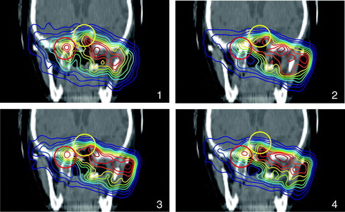Figure 7.  β+-activity distributions superimposed onto a patient CT. (1) shows the measurement, (2) simulation without considering the washout, (3) simulation with a weighted mean of T1/2(biol), (4) a dose dependent T1/2(biol) was used. The circles are to guide the eyes where an improvement of the simulation over a biological half life is obvious.