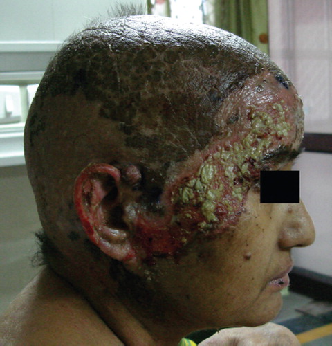 Figure 1. Lateral view of the patient showing extensive desquamation of the scalp and ear with intensification at the treatment borders of the German helmet portal, 10 days following diagnosis of Stevens-Johnson syndrome. The lip lesions are in healing phase.
