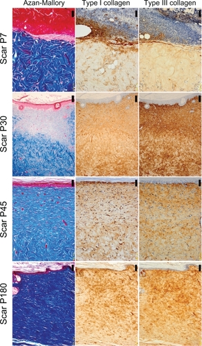 Figure 2 The histology of scar tissues (×200 magnification). The left column shows Azan-Mallory Staining, the middle column shows type I collagen staining, and the right column shows type III collagen staining. Images from top to bottom show postinjury day 7 (P7), postinjury day 30 (P30), postinjury day 45 (P45), postinjury day 180 (P180). Scale bar = 50.0 μm.