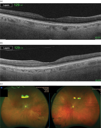 Figure 4. a, b and c OCT- and UWFI-images from a 70-year-old patient with homocystinuria. OCT showing bilateral retinal atrophy. UWFI-images showing bilateral peripheral pigmentary changes and retinal atrophy.