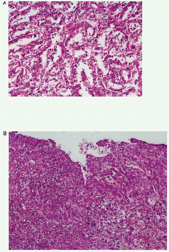 Figure 3. (A) Tubulopapillary arrangement of neoplastic cells (×100); (B) normal urothelium with malignant transformation and stromal invasion (×100).