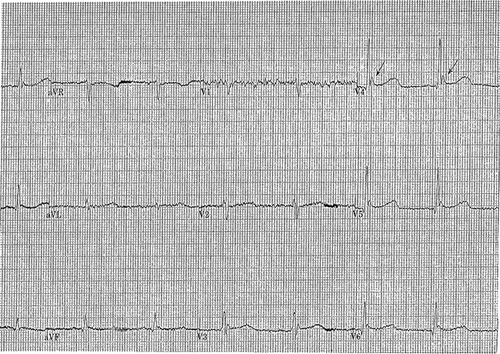 Figure 1. EKG with hypothermia prior to rewarming.Note: Osborn waves indicated by arrows.