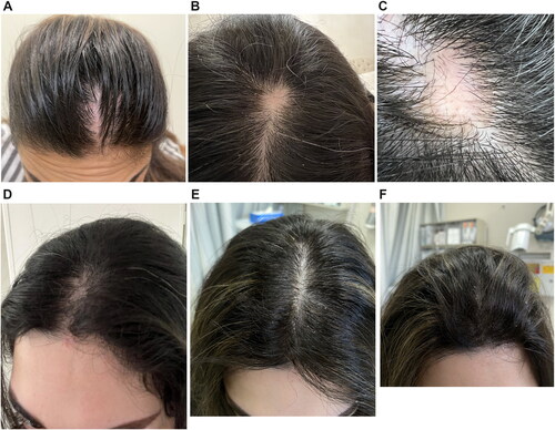 Figure 1. Patches of cicatricial alopecia involving the frontal scalp showing (A) Pre-treatment linear patch of hair loss with underlying erythema on the frontal scalp region (B) Pre-treatment well-defined patches of hair loss extending to parietal scalp. (C) Well-defined patch of hair loss on parietal scalp with white patches on background of erythema with mild perifollicular scaling on periphery, single hairs and loss of follicular ostia. (D) Pre-treatment linear depression on forehead. Post-treatment scalp (E) and (F) at week 20 after 10 doses of subcutaneous Ixekizumab showing complete hair regrowth with no evident erythema.