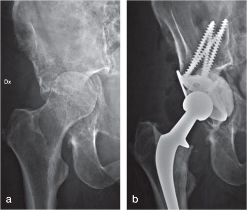Figure 1. A 66-year-old woman with metastatic destruction of the left acetabulum from breast cancer, and protrusion of the caput (a). Reconstruction was done with a Müller cage, multiple retrograde screws, and a cemented total hip arthroplasty using a Spectron femoral stem (b).
