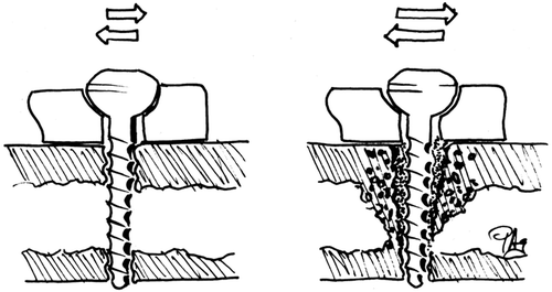 Figure 3. The observation that microinstability of a screw may lead to resorption and gross loosening may explain the role of local fluid flow in bone resorption. Forces and hydrostatic pressure around a microunstable screw are not greater than around a fixed one, but local fluid flows are. Drawn from memory of a drawing by Perren.