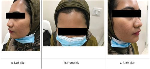 Figure 3. Photo of the face 3 month after RFM treatment, chemical peel and LED therapy completed. There was an improvement in the texture and color on patient’s skin. The lesions on the forehead were overcome.