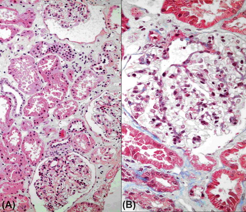 Figure 2.  Glomeruli had no significant alterations light microscopically [(A) hematoxylin and eosin stain, ×200 magnification and (B) Masson’s trichrome stain, ×400 magnification].