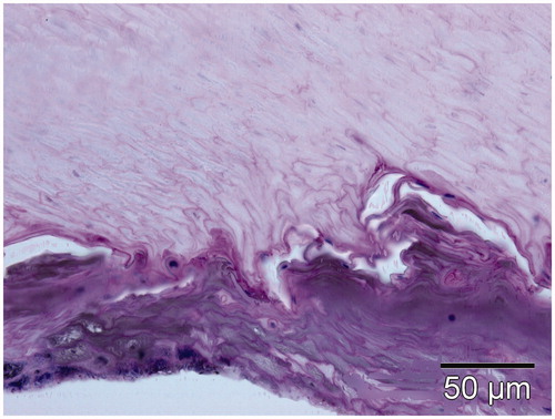 Figure 3. Histology of a nail clipping after applying a 1064-nm long pulsed Nd:YAG laser at a fluence of 70 J/cm2 and a pulse duration of 40 ms (three passes), PAS (Periodic acid Schiff).